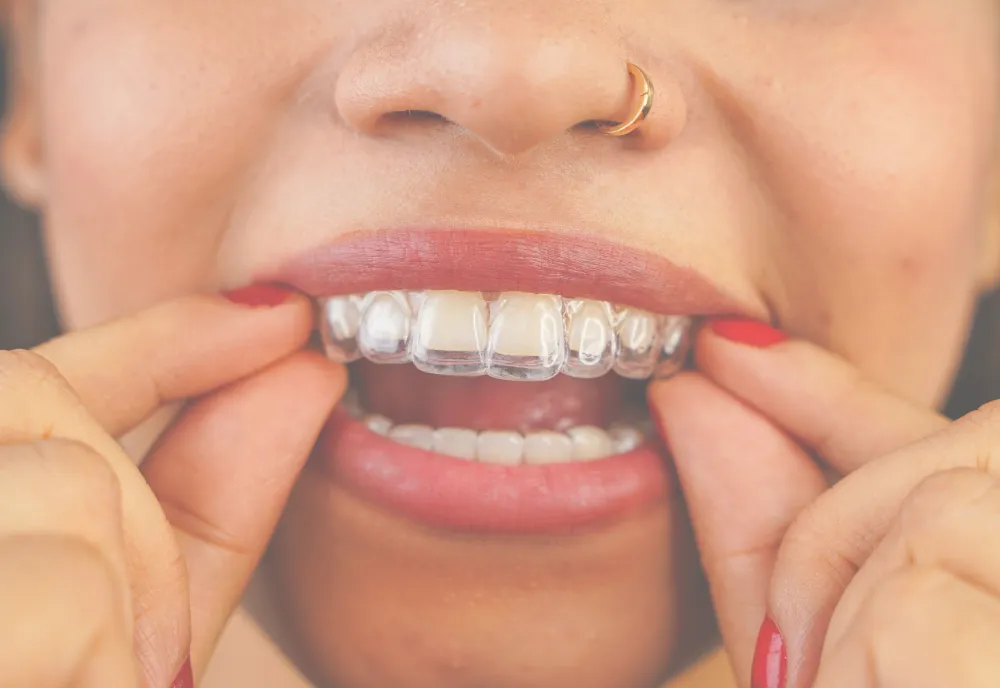 From clear aligners to Cfast cosmetic tooth alignment and fixed braces, Dental Expressions helps patients explore straighter smile options with professional guidance. || Your dentist can assess your teeth and explain which approach may suit your goals, lifestyle and dental needs.